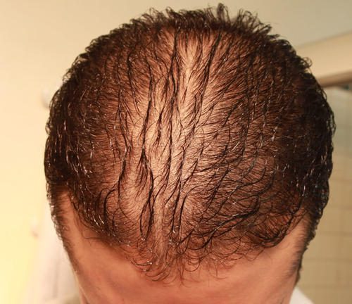 Photo of What is Diffuse Hair Loss?