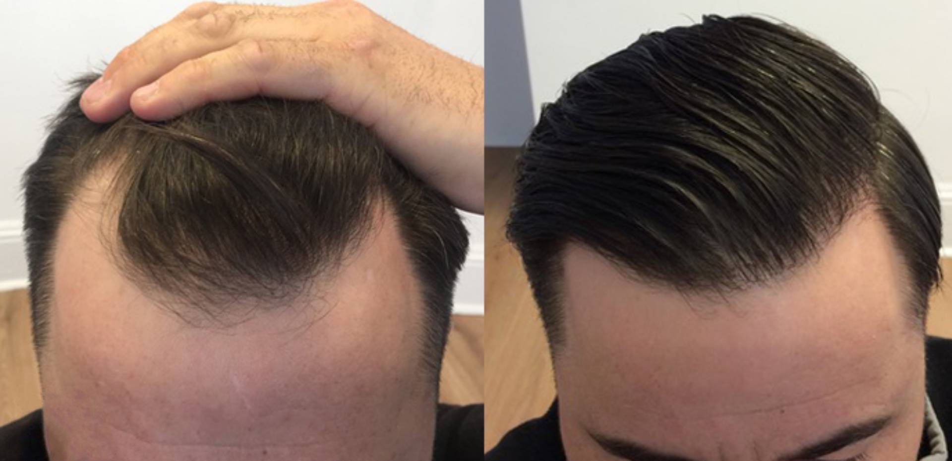 Photo of Things To Know About The FUE Hairline Lowering Procedure