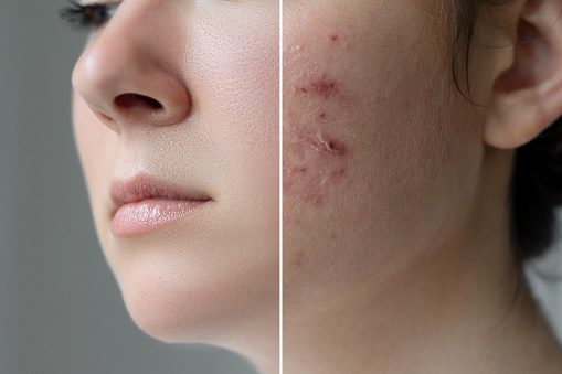 Photo of Top 5 Tips for remove acne in only 30 days