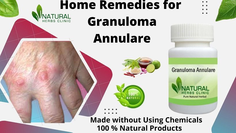 Photo of Herbal Supplement for Granuloma Annulare Recommendations to become Free of Skin Disease