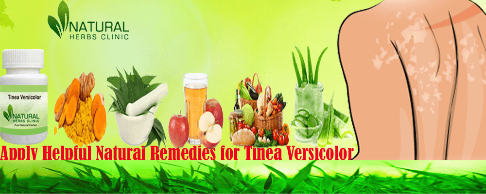 Photo of Home Remedies and Herbal Products for Tinea Versicolor