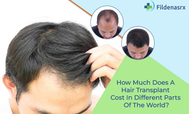 Photo of How Much Does A Hair Transplant Cost In Different Parts Of The World?