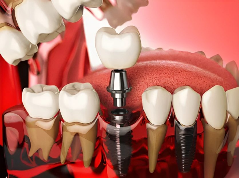 Photo of Get to know the benefits of Virginia dental implant sand procedures.